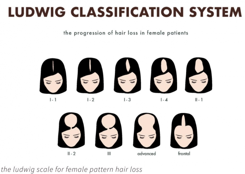 Ludwig hair loss scale